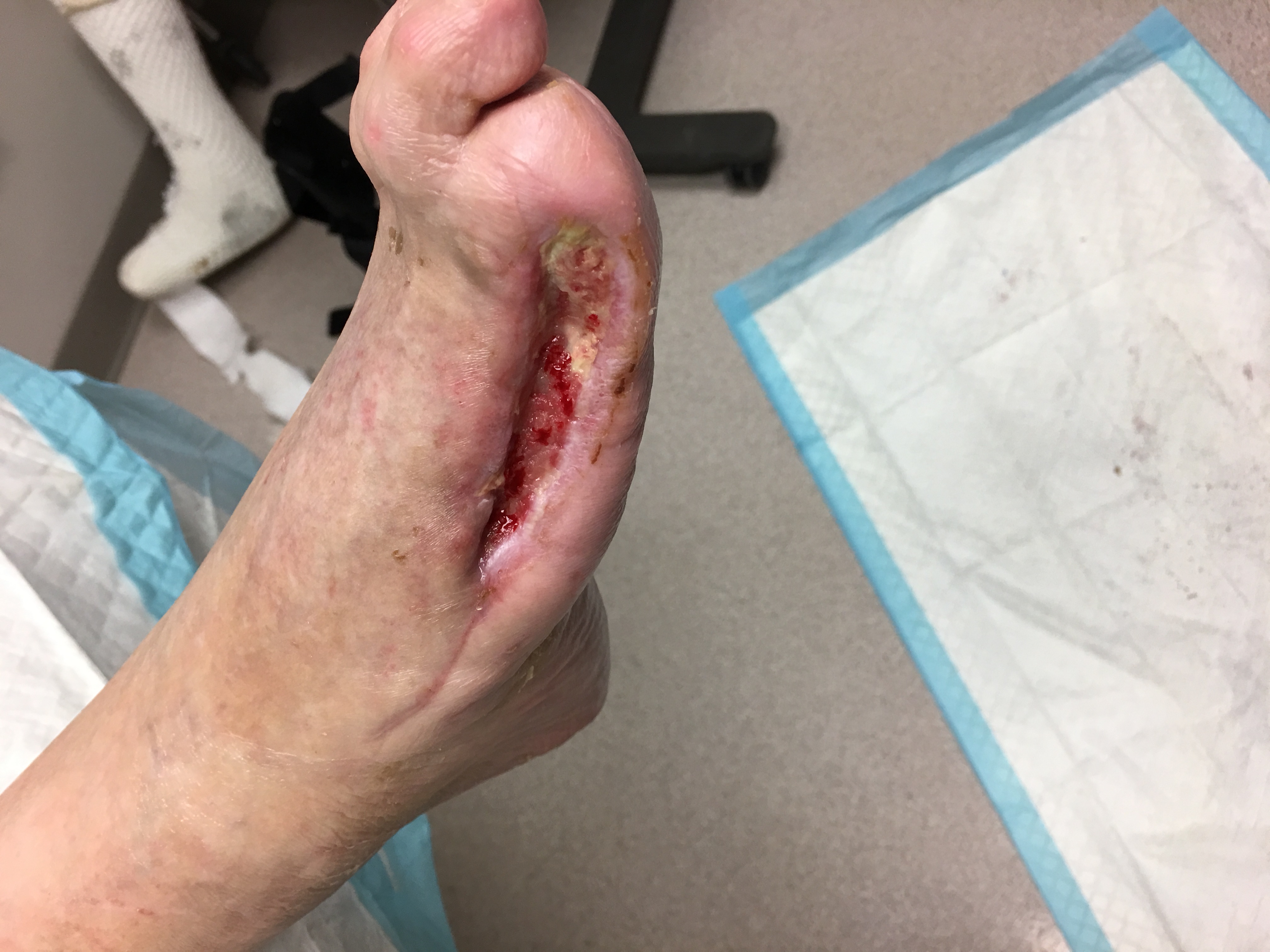 Surgical wound with continued closure